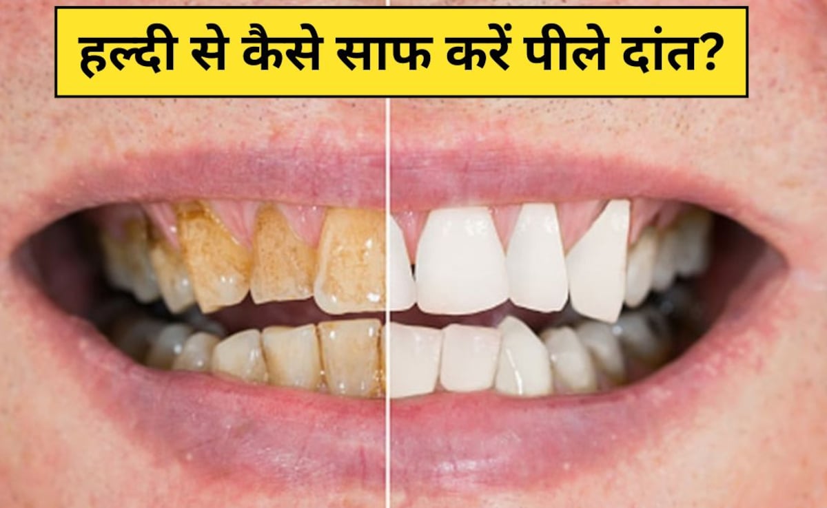 हल्दी से कैसे साफ करें पीले दांत? Dr. Hansaji Yogendra ने बताया इन 2 तरीकों से साफ हो जाएगी दांतों की पीली परत, मोती जैसे दिखेंगे Teeth