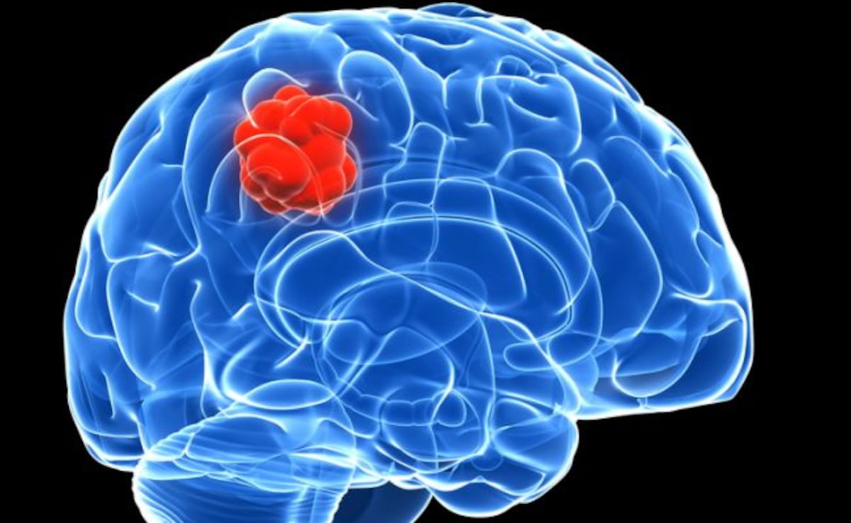 World Brain Tumor Day 2025: ब्रेन ट्यूमर के लक्षण कारण और इलाज क्या हैं? किन संकतों से पहचानें कि ट्यूमर बन गया है