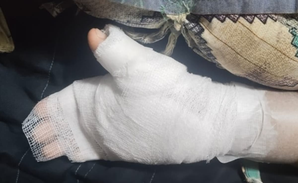 Mumbai Teacher Burns 8-Year-Old’s Hand With Candle Over Bad Handwriting