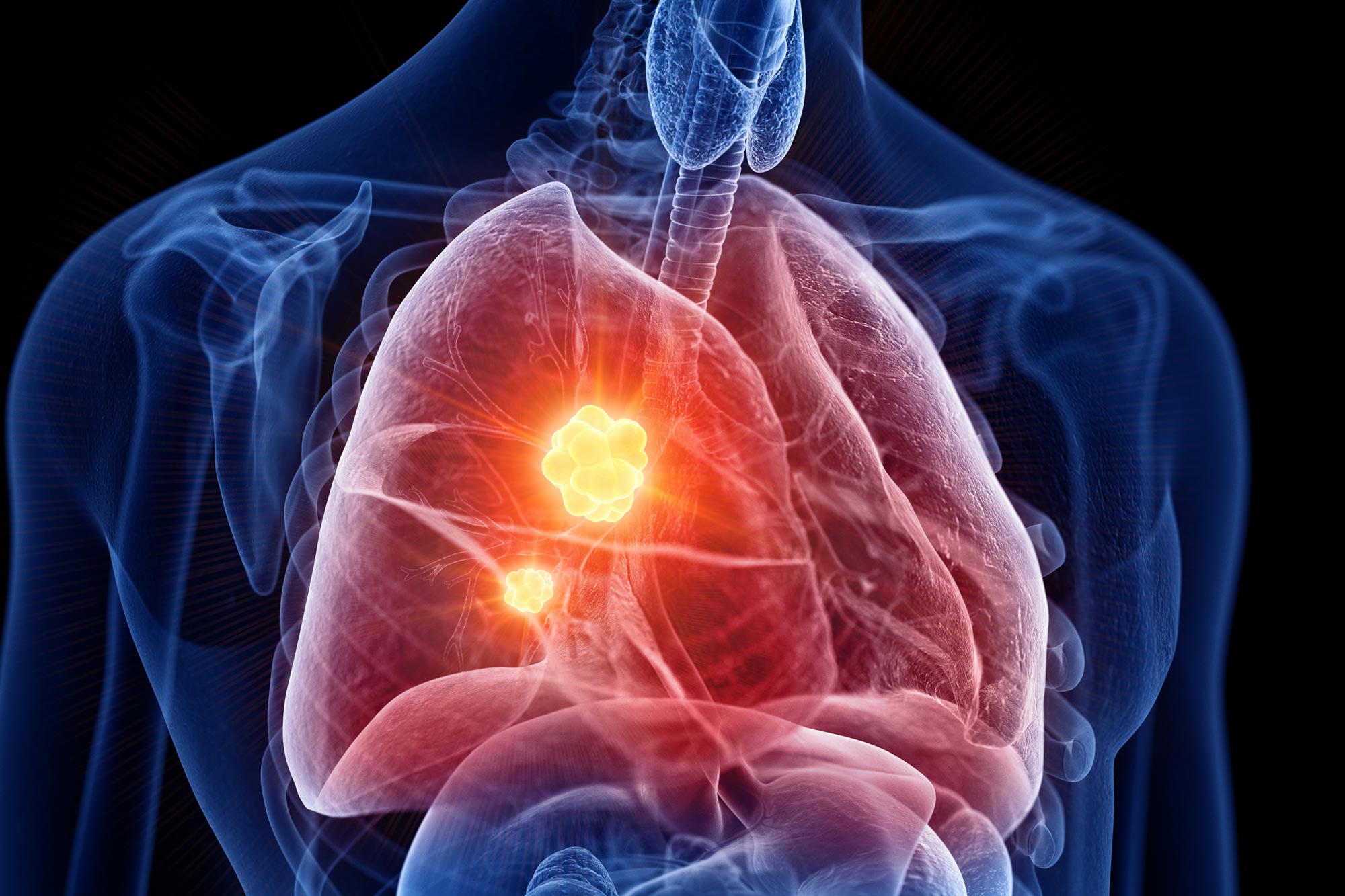Bharat Journal Marijuana Use May Raise Lung Cancer Chance, Researchers Warn