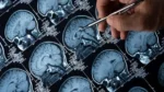 Low accumulation of abdominal fat in midlife linked with slow brain atrophy 